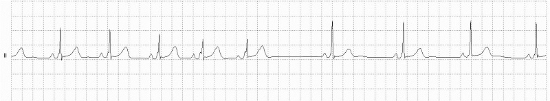 Wolff-Parkinson-White (WPW) Rhythm Strip